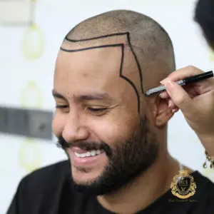 Sac Ekimi Kalici midir