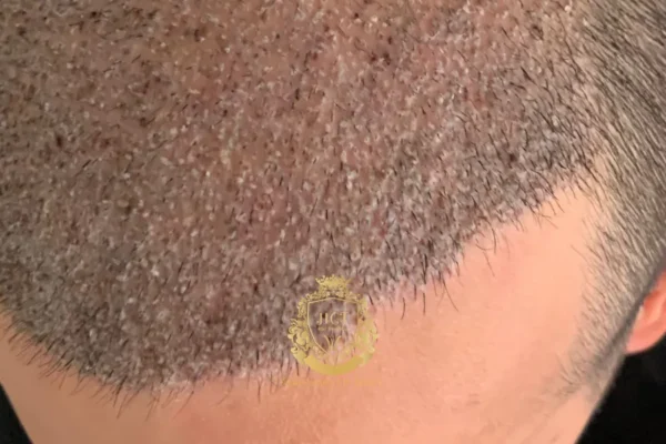 Wat is korstvorming na een haartransplantatie?