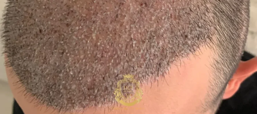 O que é a formação de crostas após o transplante capilar?