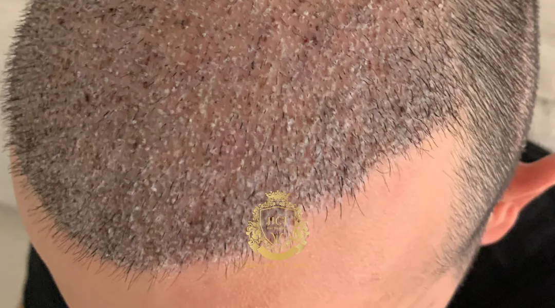 What is Crusting After Hair Transplant?