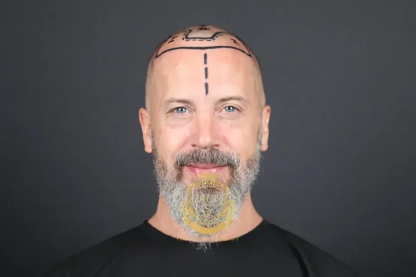 Wie komt niet in aanmerking voor een haartransplantatie?