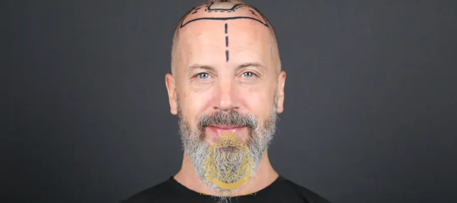 Voor wie is een haartransplantatie niet geschikt?