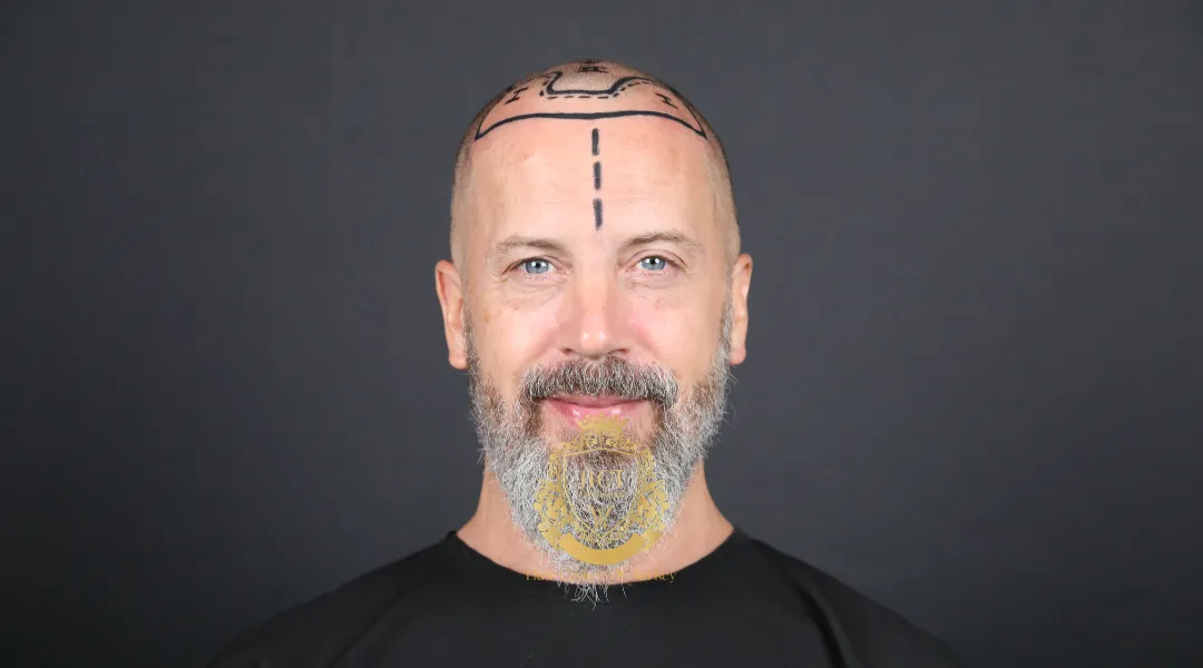 Voor wie is een haartransplantatie niet geschikt?