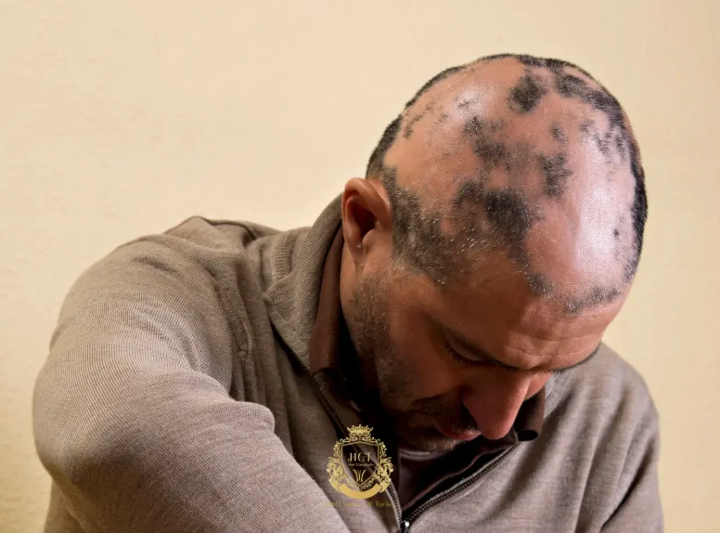 Androgenetic Alopecia / Male Pattern Hair Loss