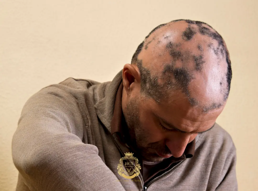 Androjenetik Alopesi / Erkek Tipi Saç Dökülmesi