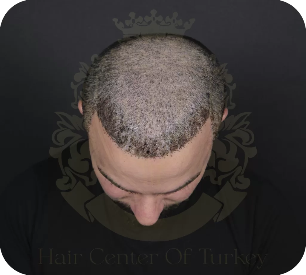 What Causes Crusting After Hair Transplant?