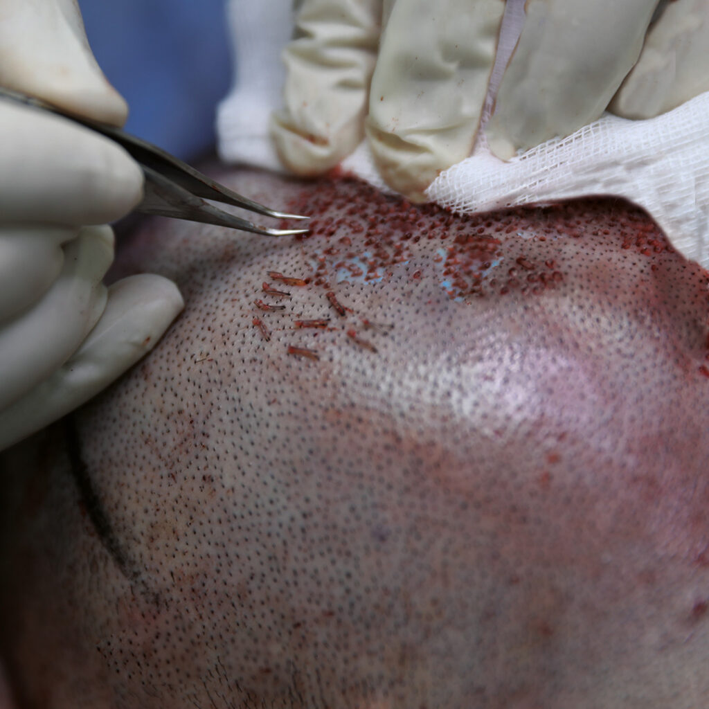 Does Donor Hair Grow Back After Hair Transplant?