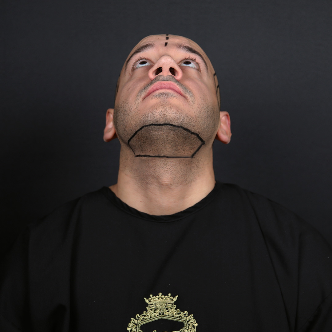 donör bölge1 Does Donor Hair Grow Back After
Hair Transplant?