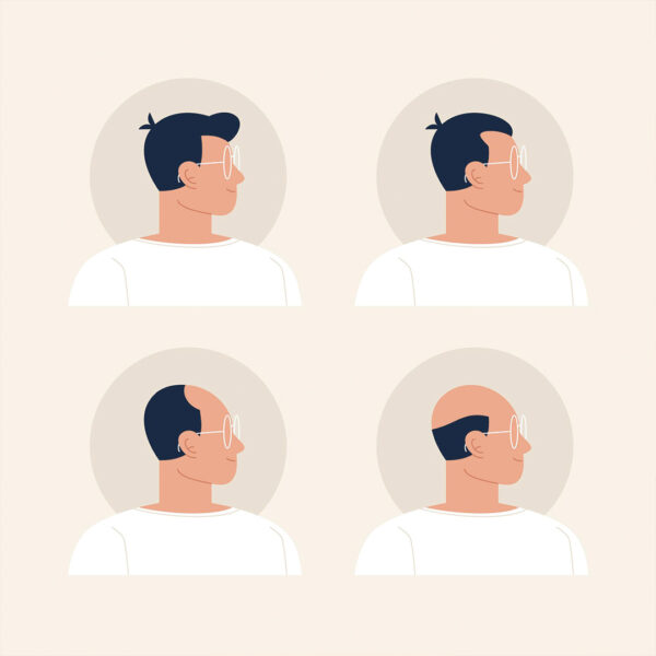 hair loss in men