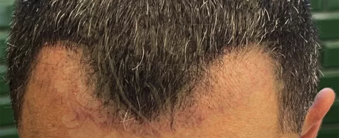 Shock Loss After Hair Transplant