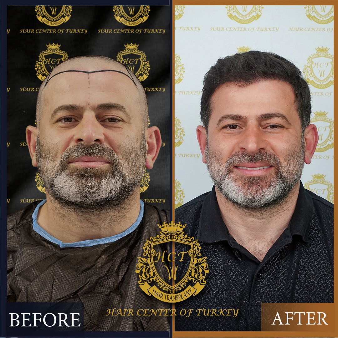 türkiyede saç ekimi sonuçlar3 Hair Transplant Turkey Before and After