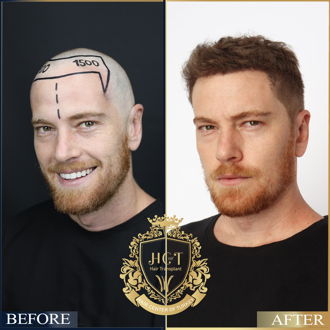 Hair Transplant turkey Before After
