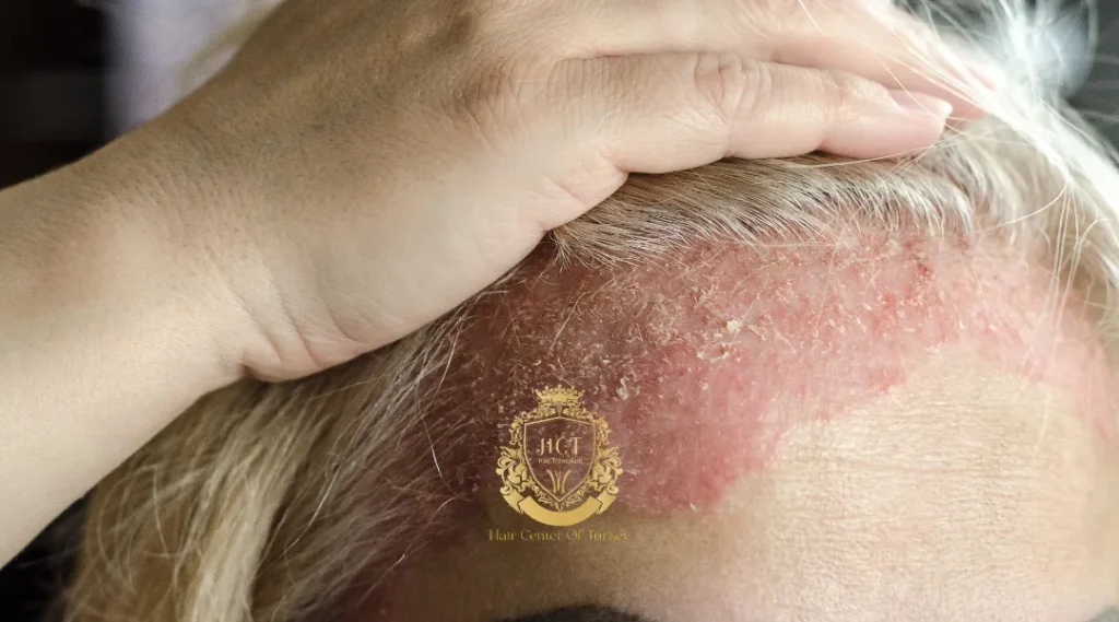 Is Hair Transplant Performed for Skin Patients?