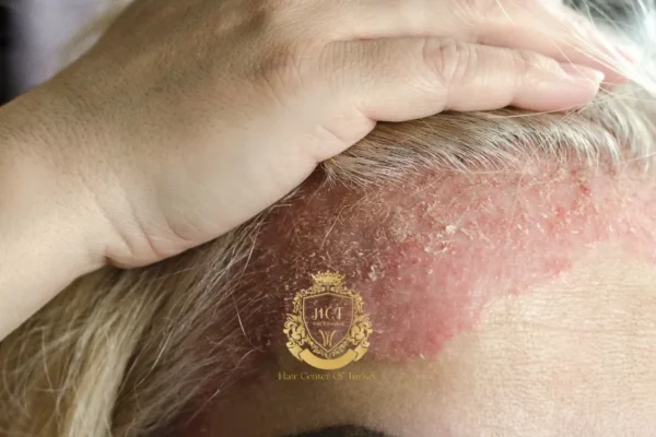 Greffe de cheveux et affections du cuir chevelu