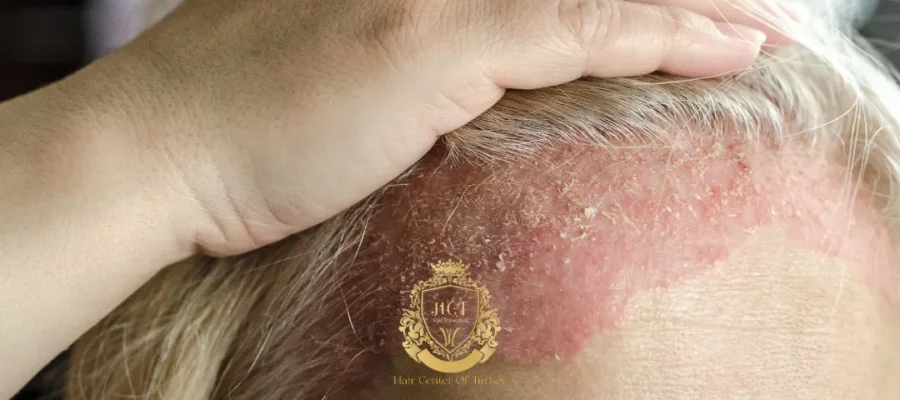 Is Hair Transplant Performed for Skin Patients?