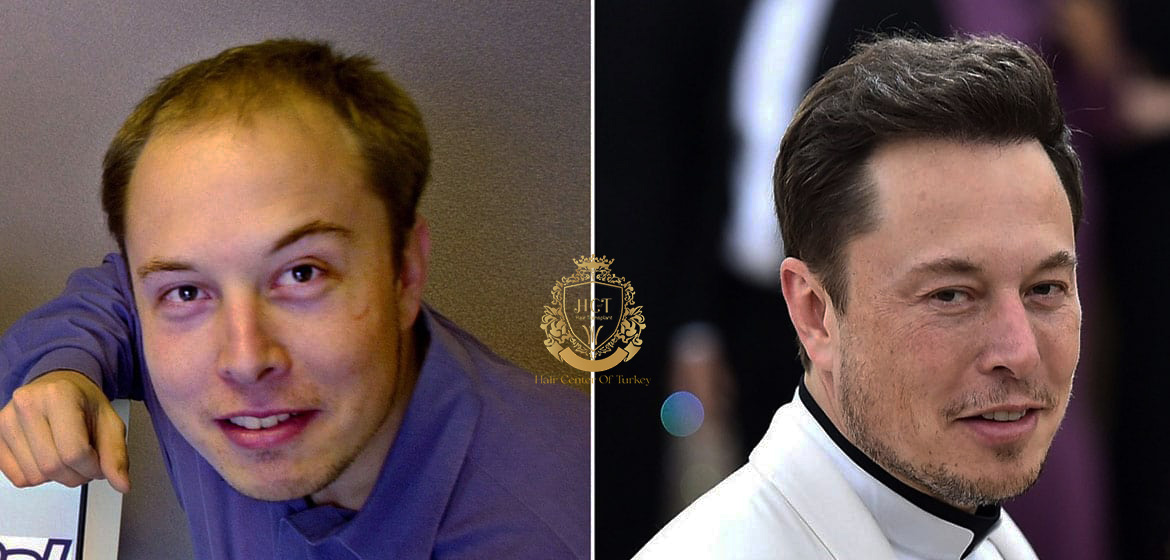 elon musk hair transplant before after 