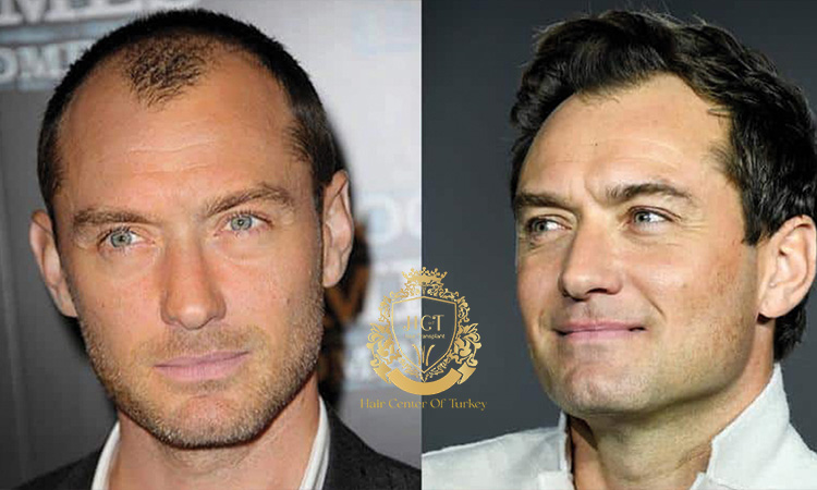 jude law hair transplant before and after