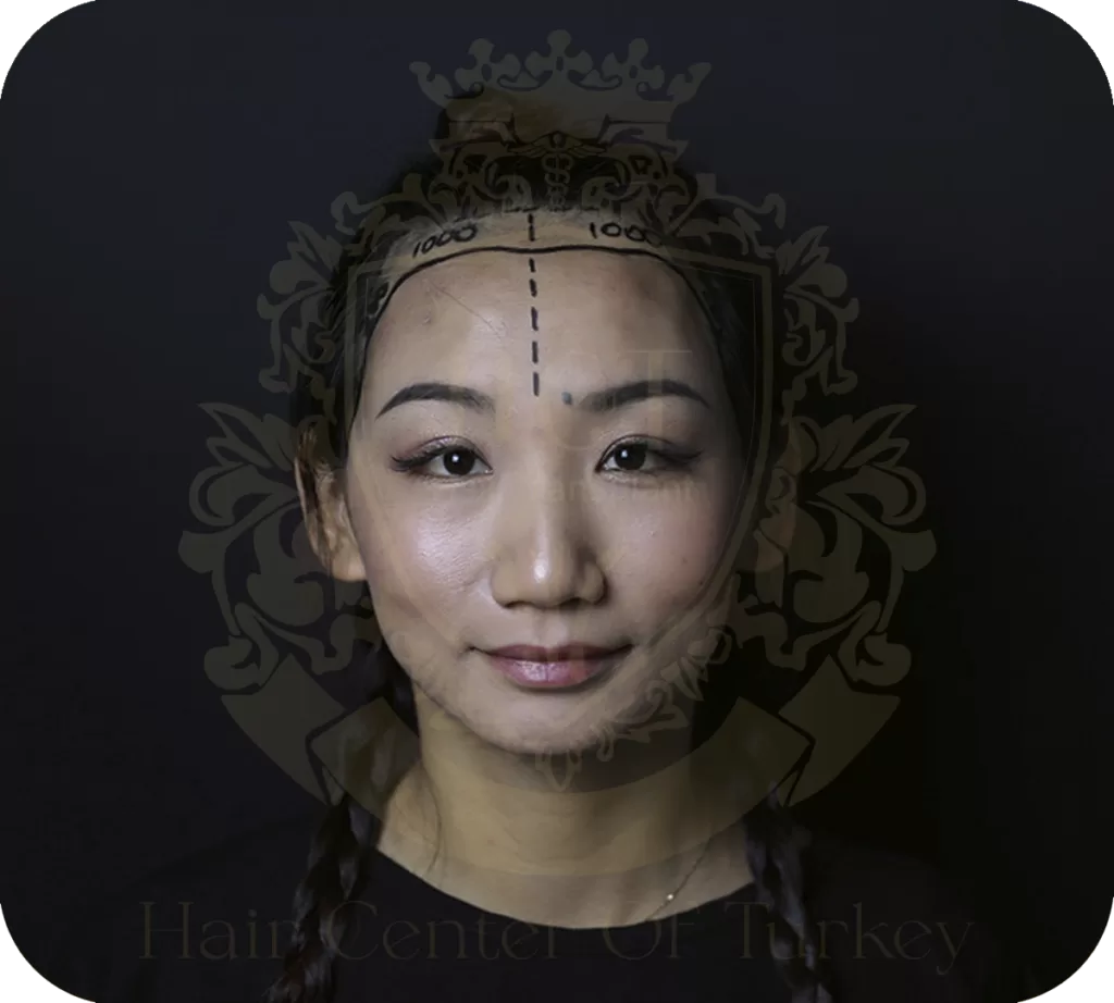 Hair Transplant for Women