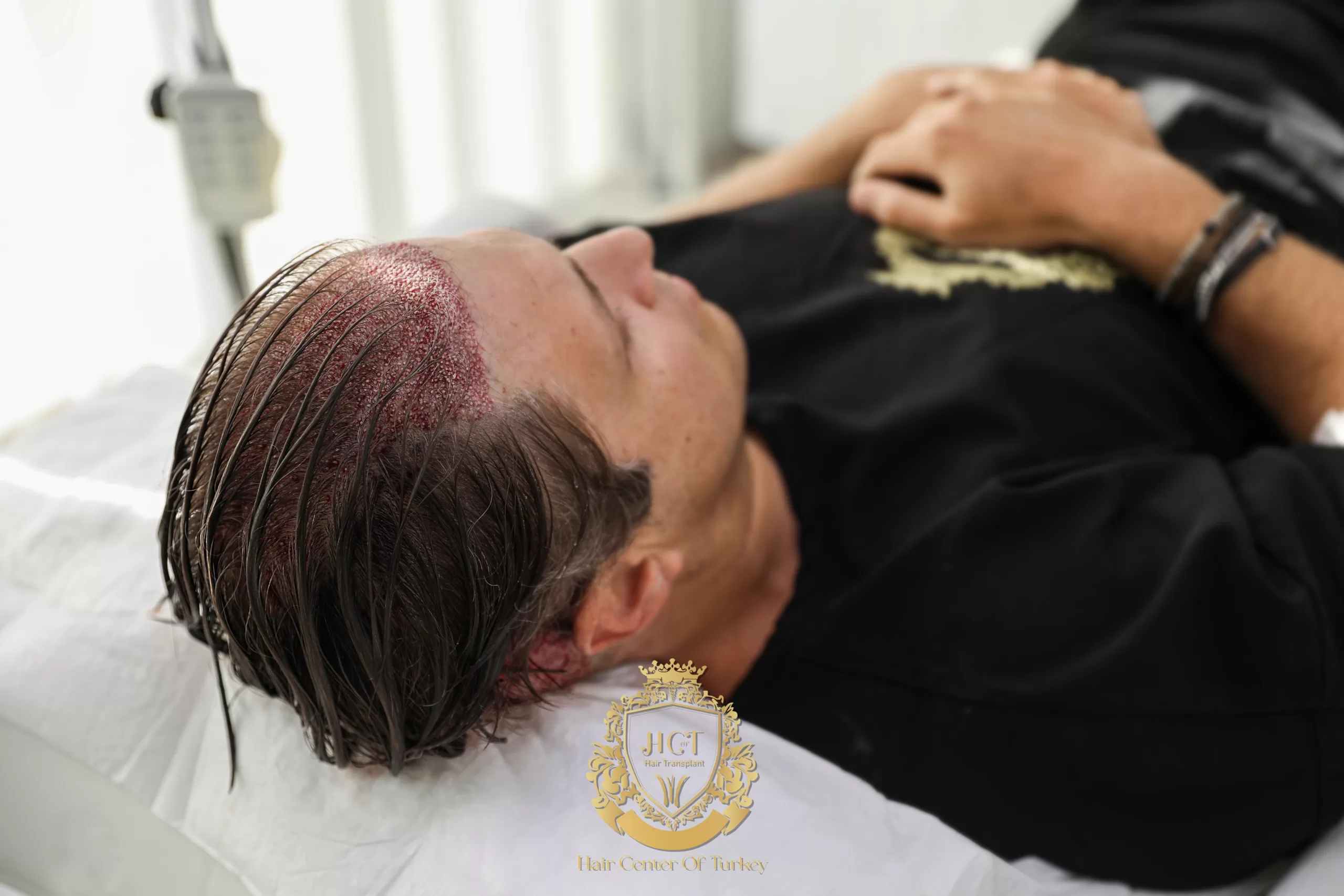 turkey hair transplant