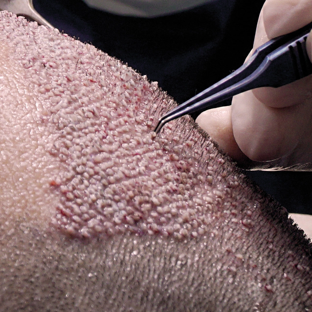 fue hair transplant what-is-hair-transplantation