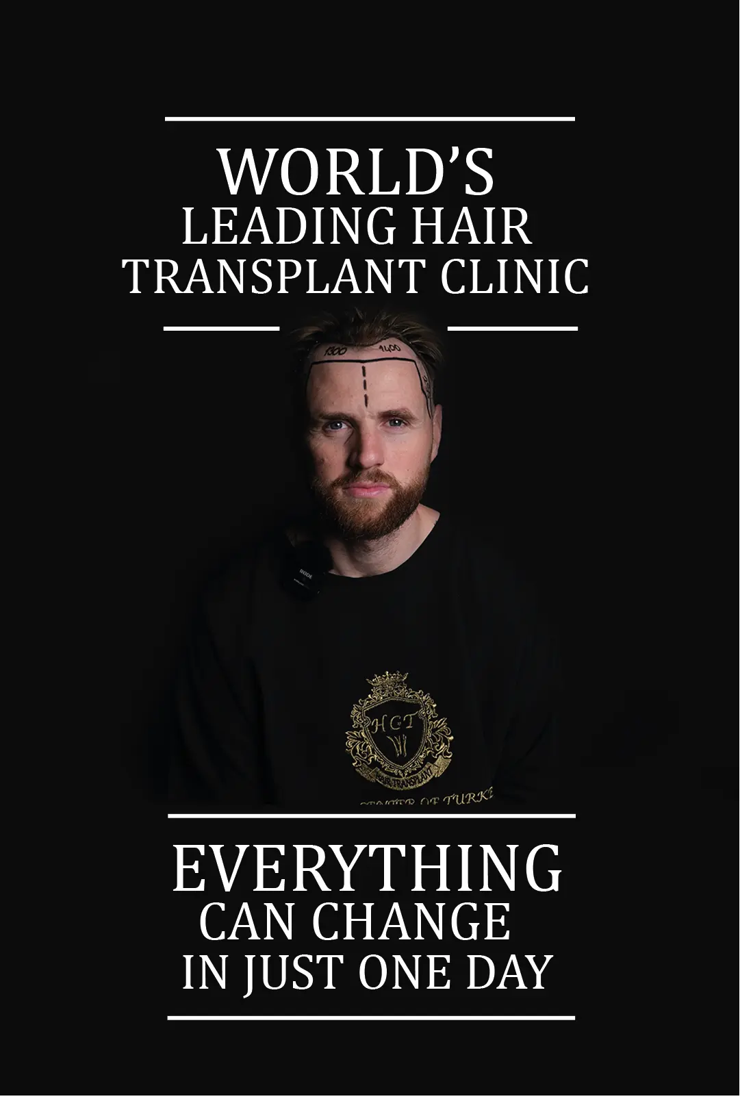 ezgif.com-gif-maker (1) hair transplant turkey