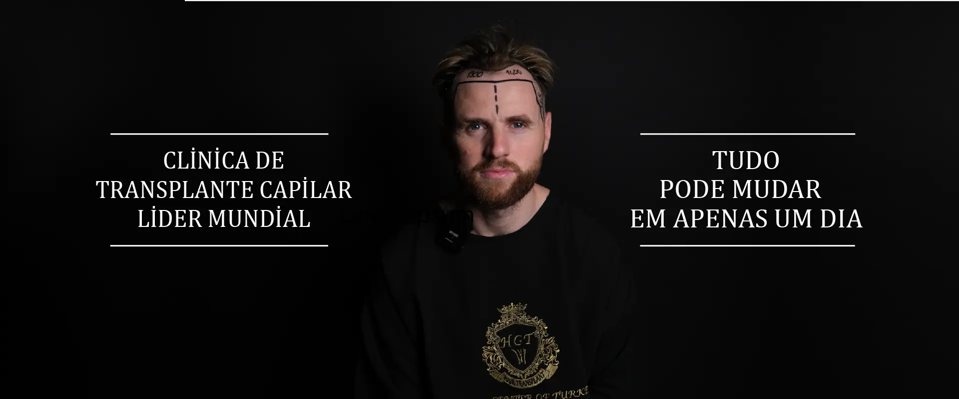 ezgif.com-gif-maker (2) hair transplant in turkey