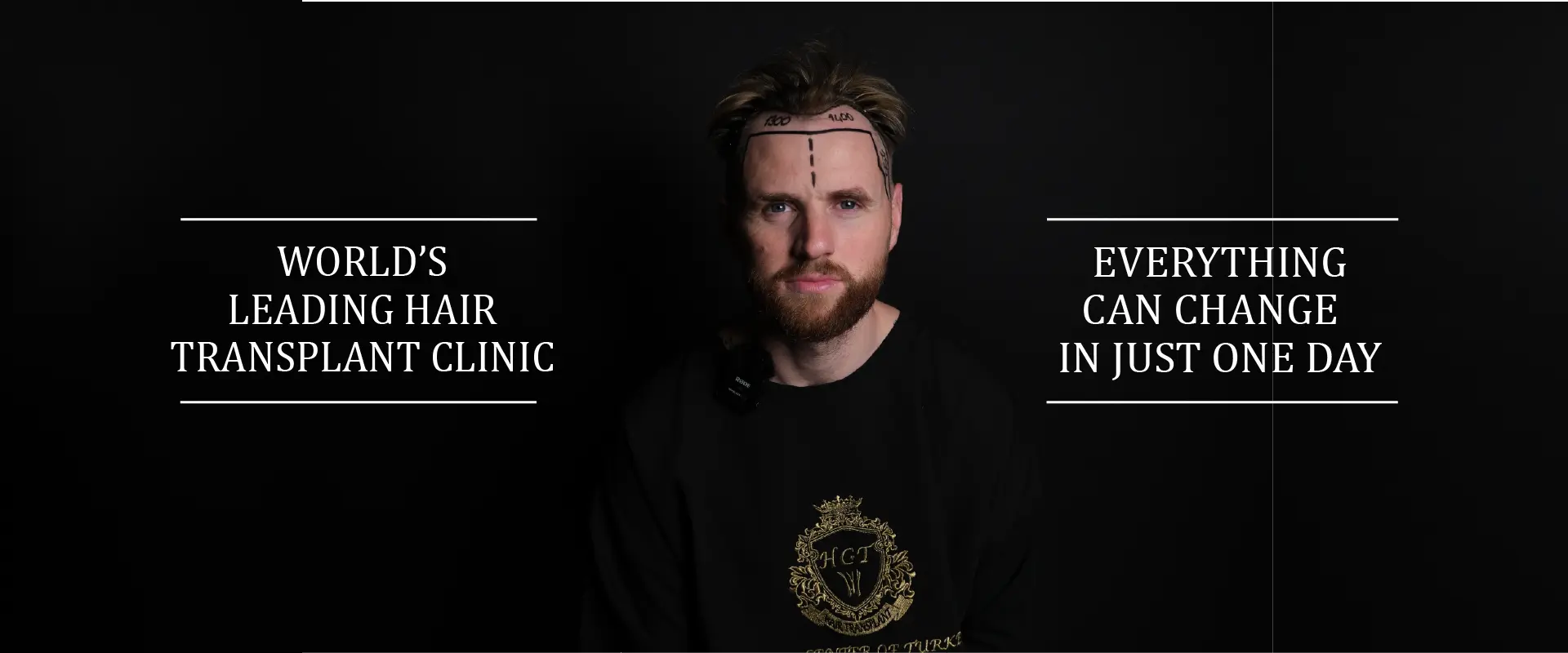 ezgif.com-gif-maker hair transplant turkey
