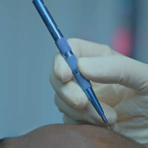 sapphire fue hair transplant