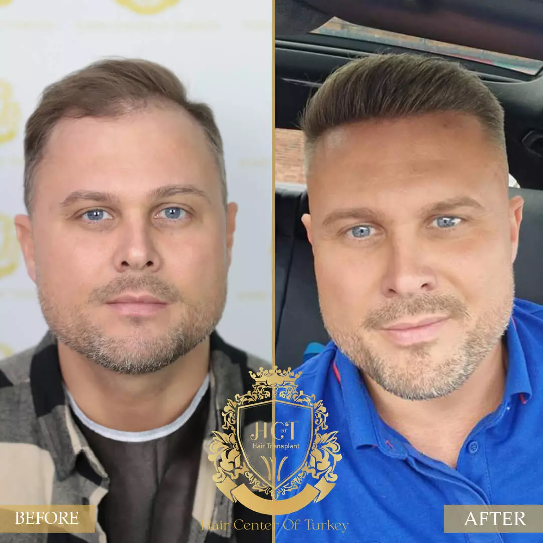Hair Transplant Before After 1