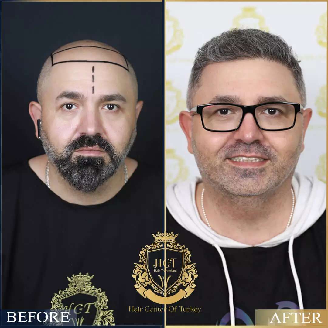 Hair Transplant Before After 10