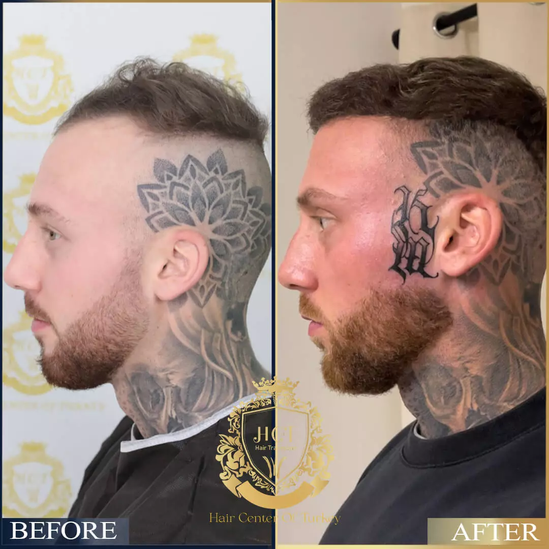 Hair Transplant Before After 12