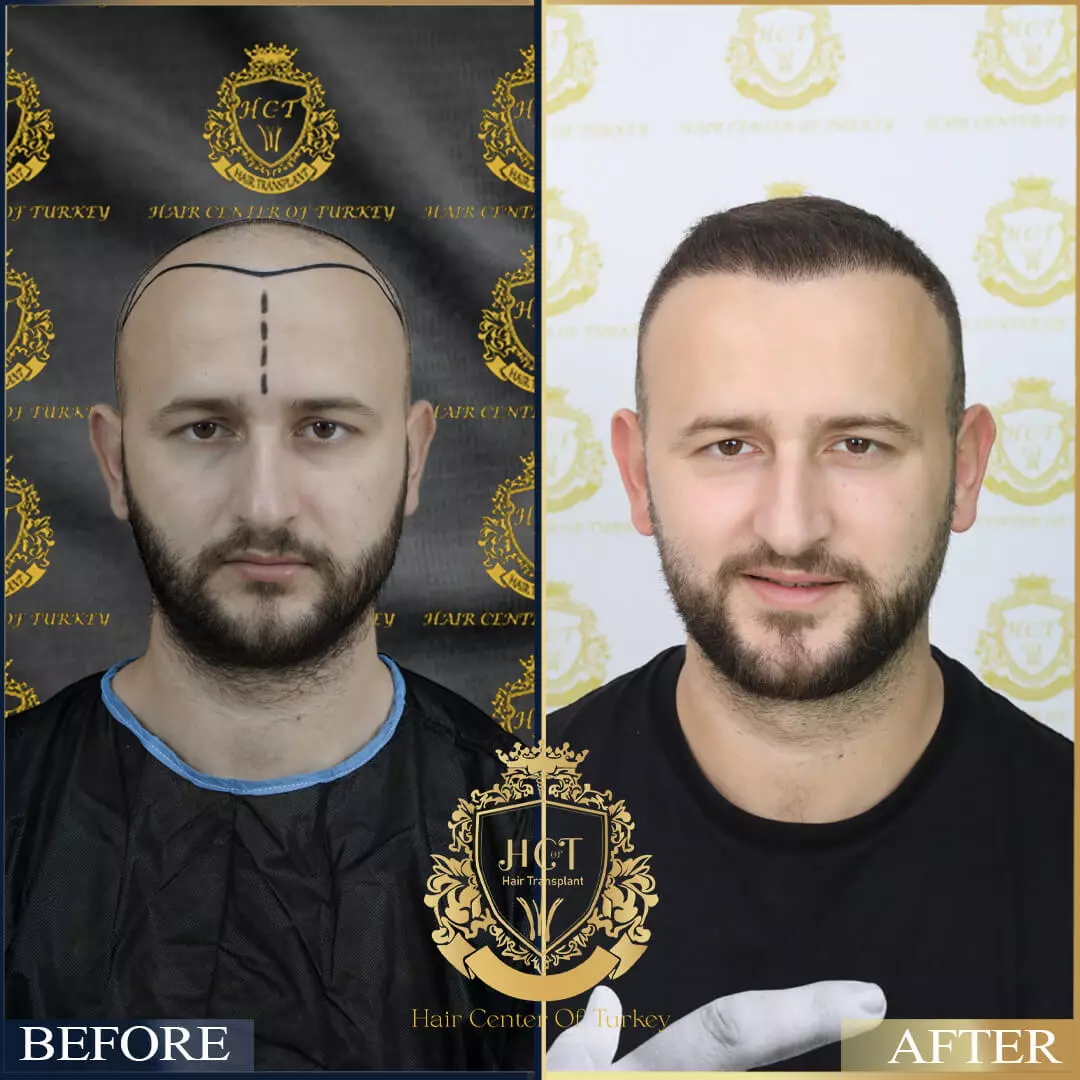 Hair Transplant Before After 13