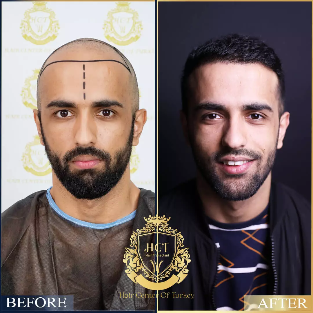 Hair Transplant Before After 14
