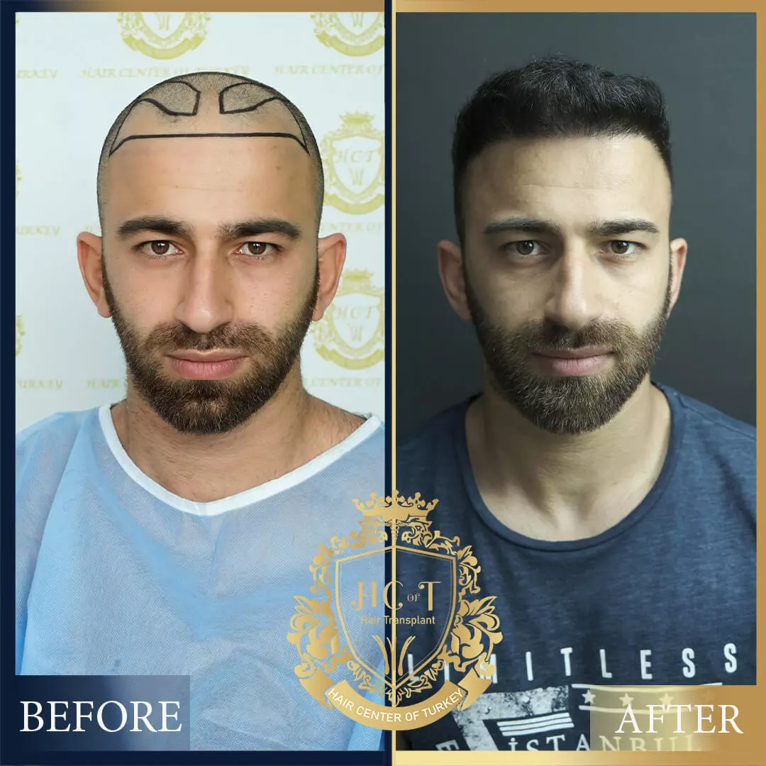 Hair Transplant Before After 19