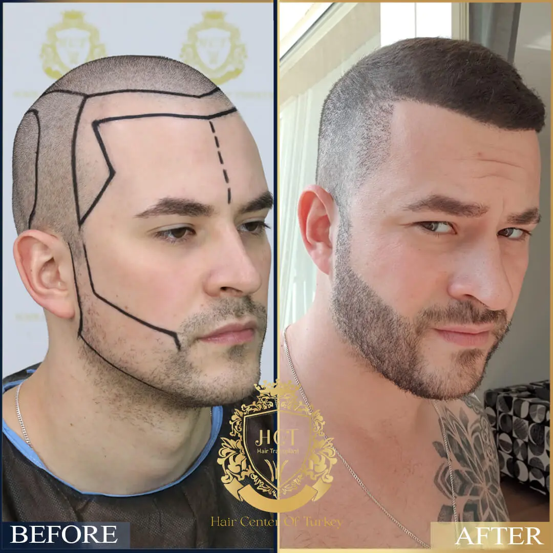 Hair Transplant Before After 22