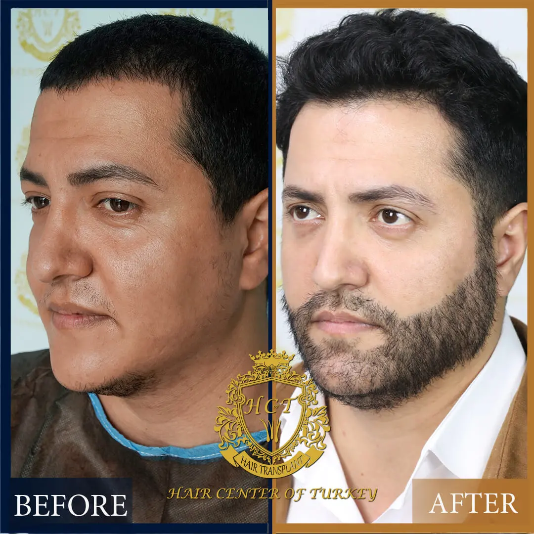Hair Transplant Before After 24