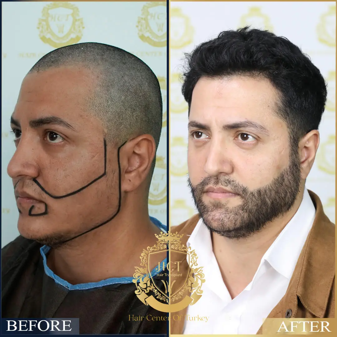 Hair Transplant Before After 25