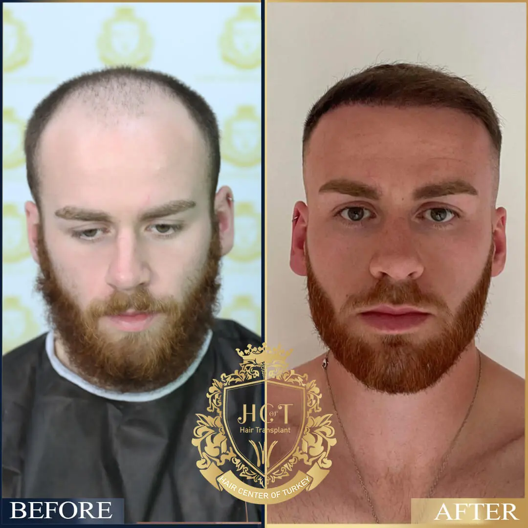 Hair Transplant Before After 27
