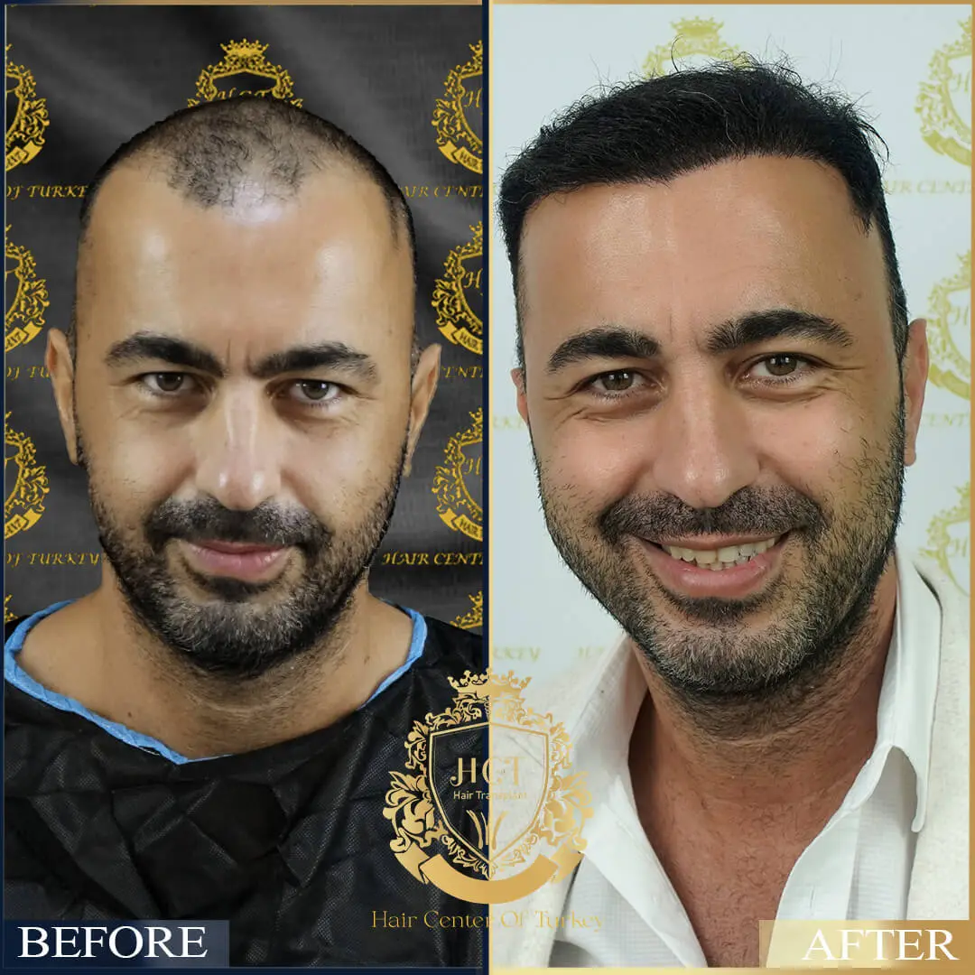 Hair Transplant Before After 28