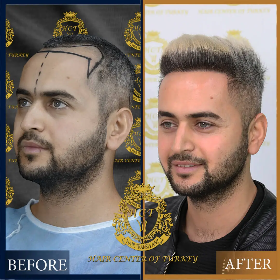 Hair Transplant Before After 29