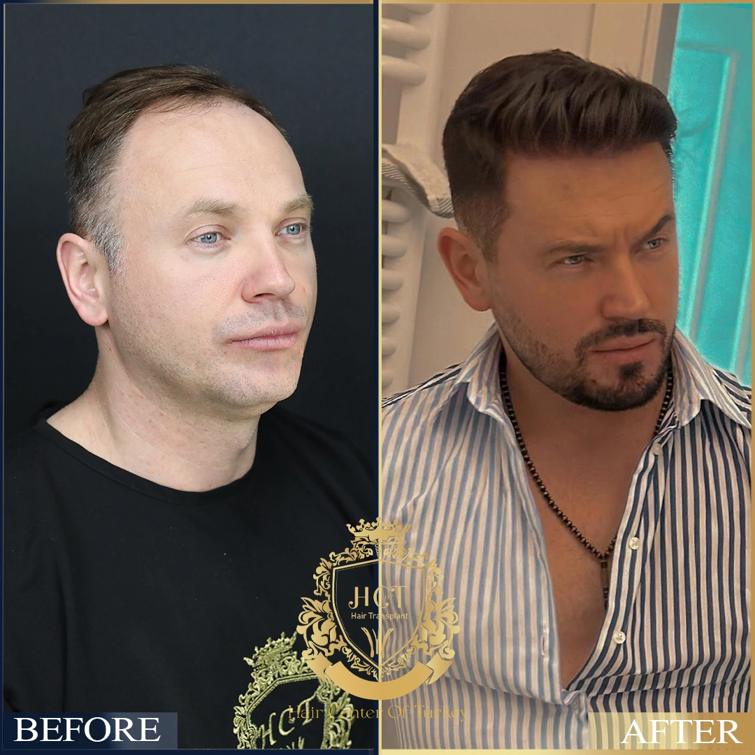 Hair Transplant Before After 31