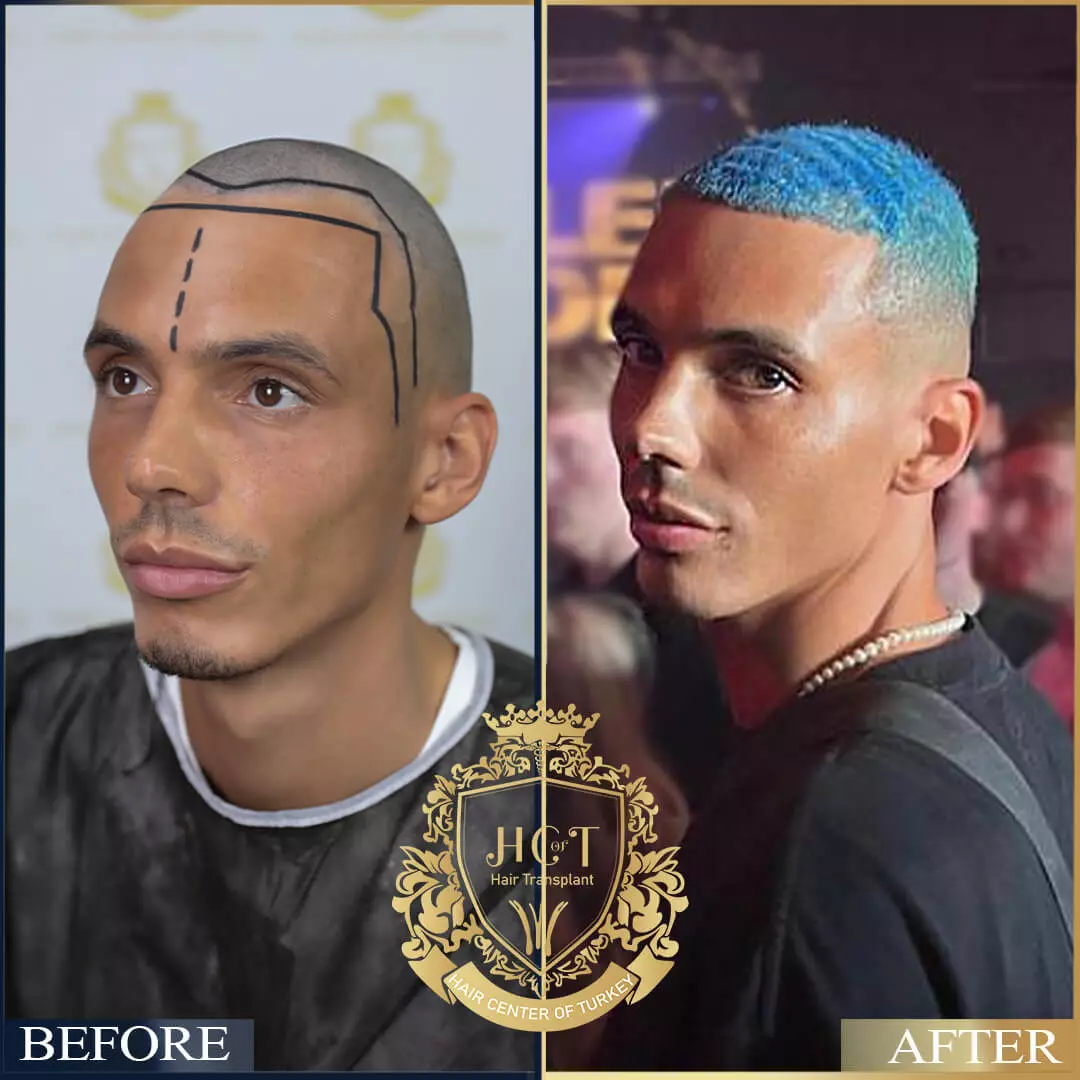 Hair Transplant Before After 4