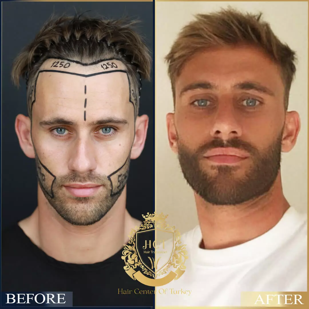 Hair Transplant Before After 5
