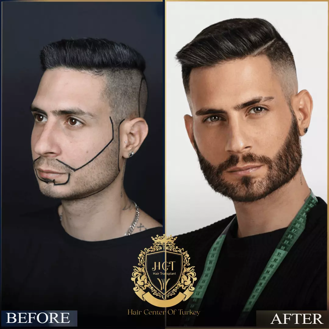 Hair Transplant Before After 6