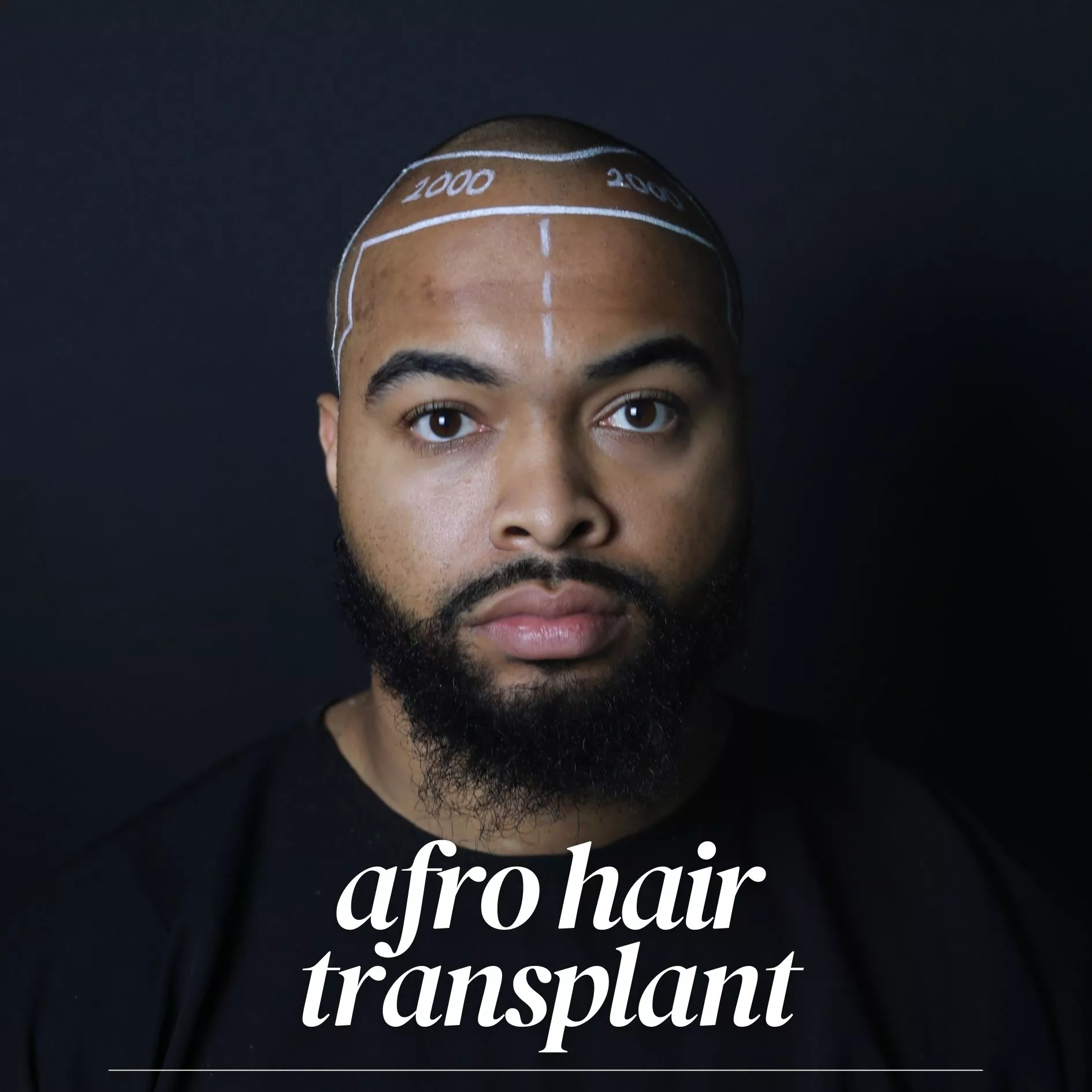 afro hair transplant