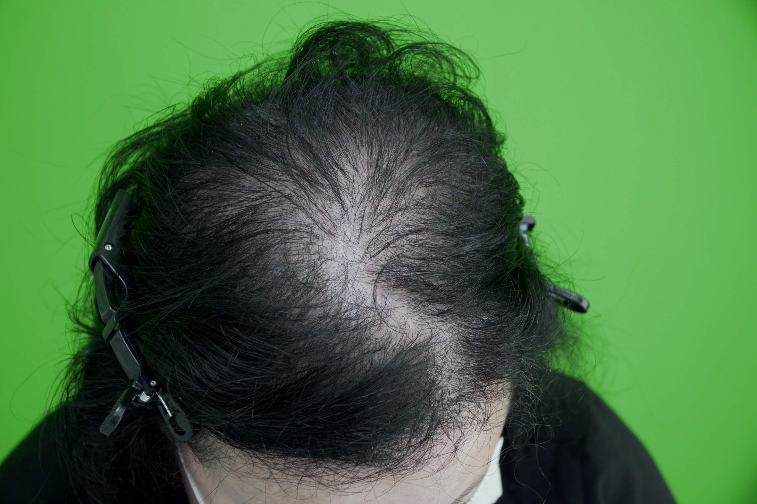 hair loss in women