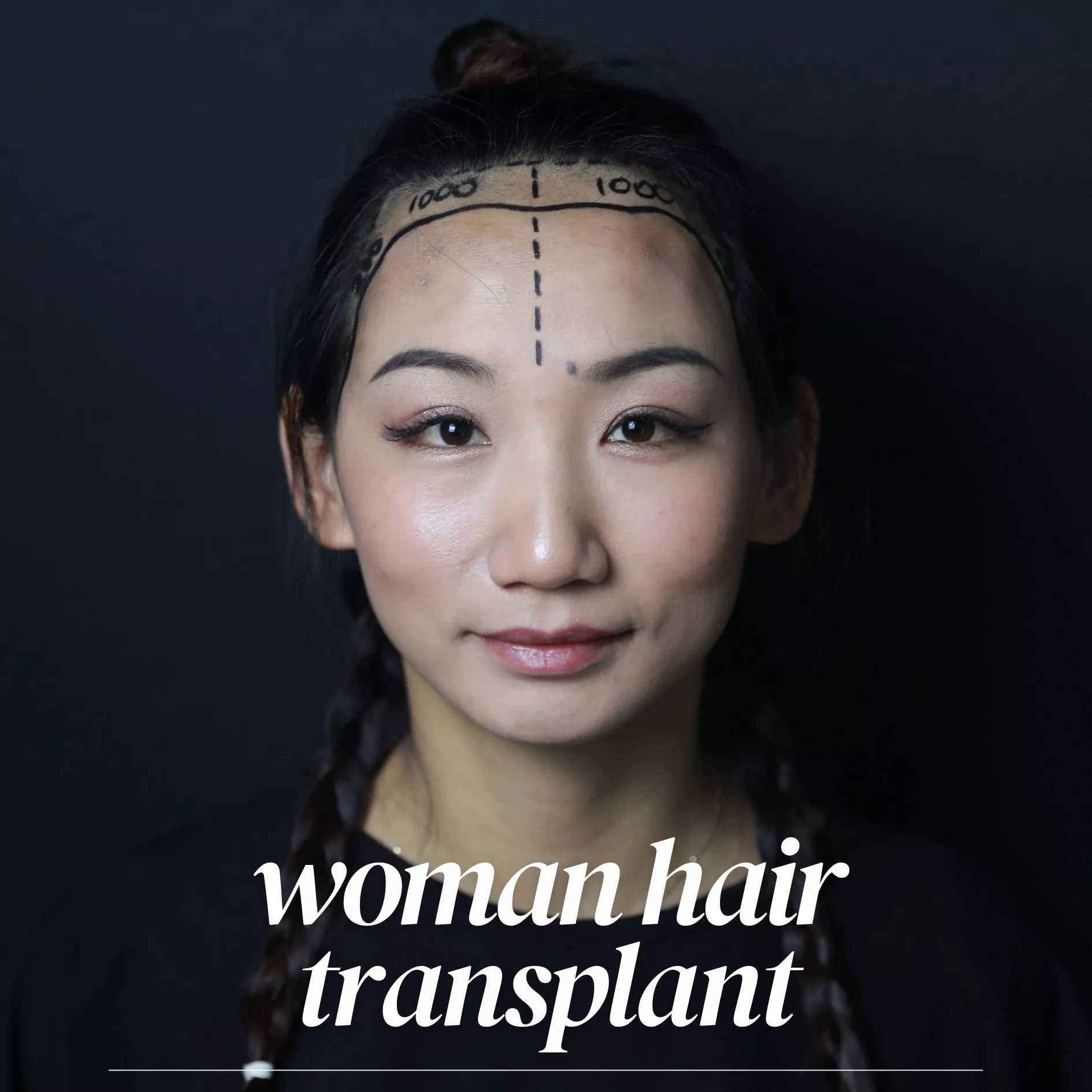 hair transplant in turkey