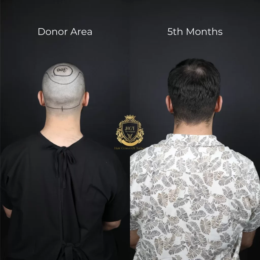 What Does the Donor Area Look Like After Hair Transplant