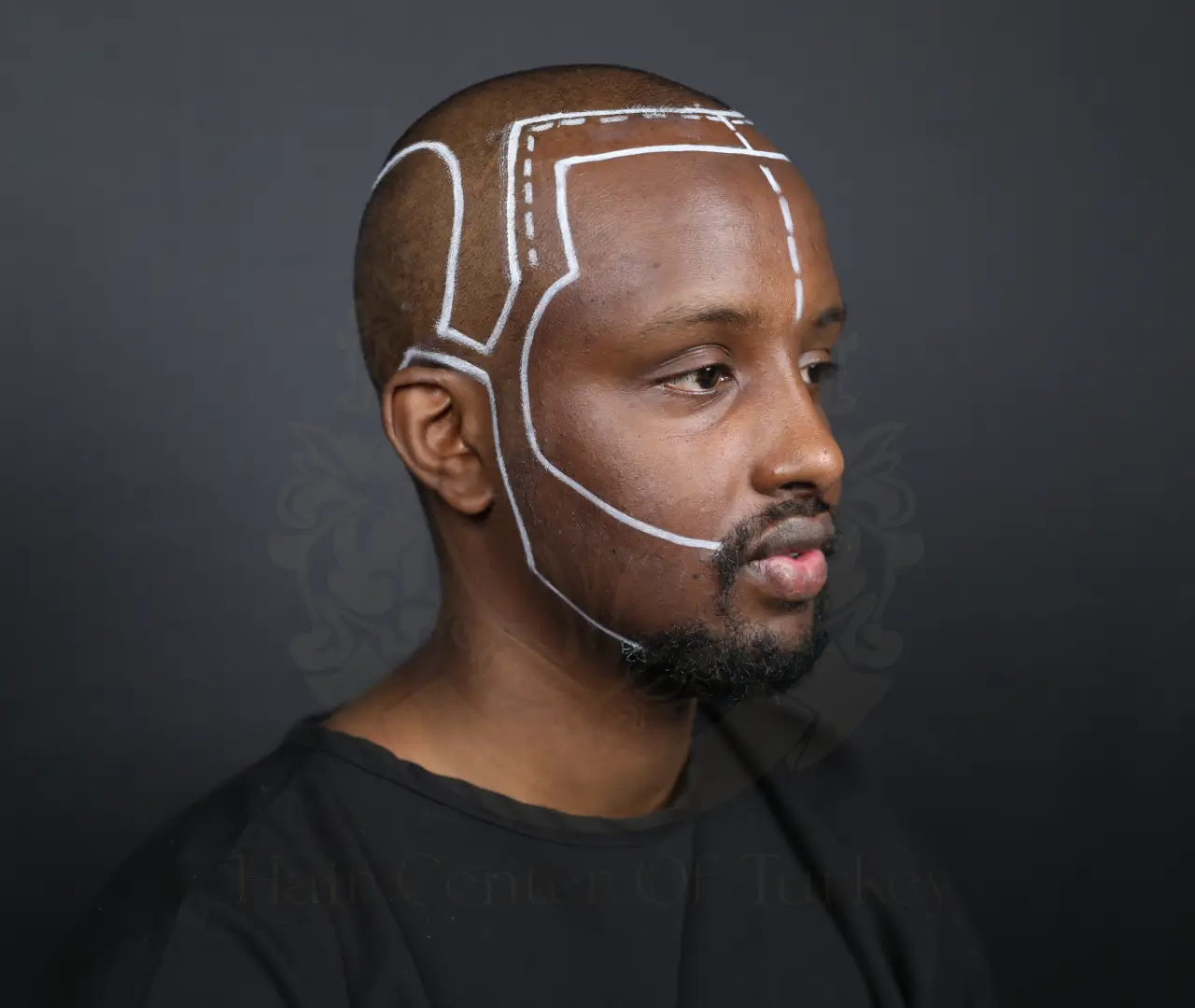 afro hair transplant