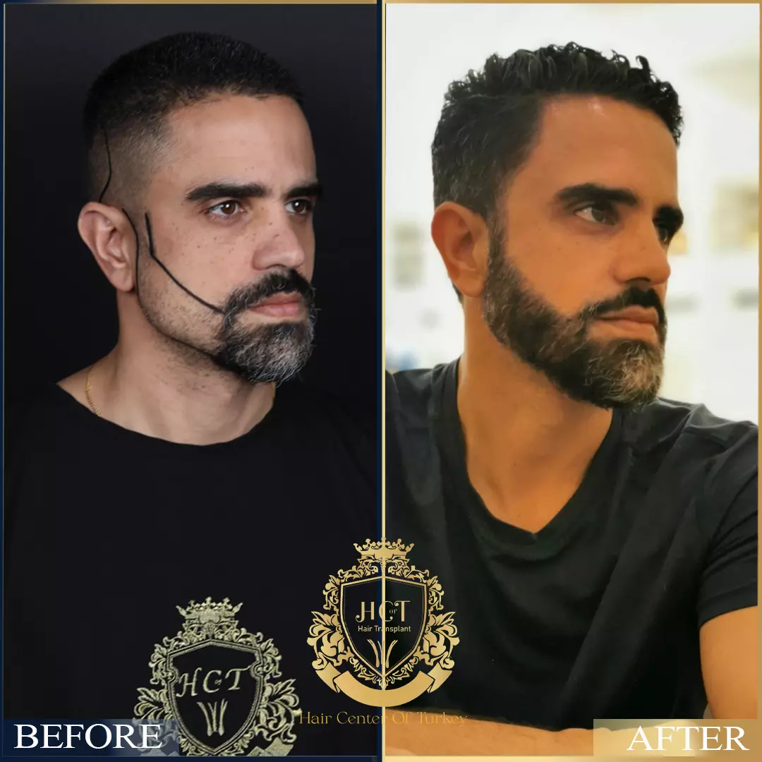 Beard Transplant Before After 1